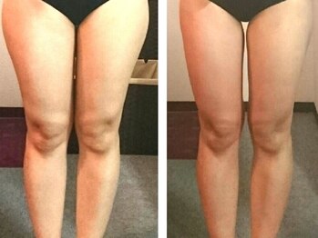 リング(R-ing)の写真/頑固な太もも・ヒップラインの脂肪をラジオ波＋クラッシュ分解+リンパ流しでトリプルアタック！70分¥3900