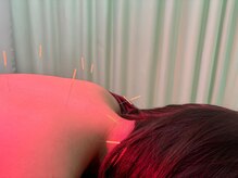 京 鍼灸院 整体院/鍼施術の風景