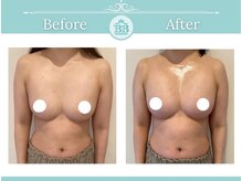 美人バスト 本厚木店/バストアップ◇症例◇