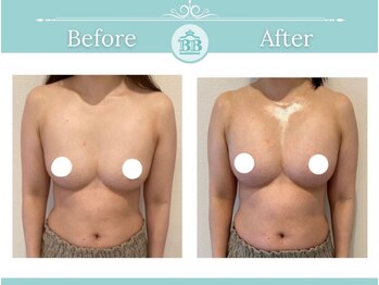 美人バスト 本厚木店/バストアップ◇症例◇