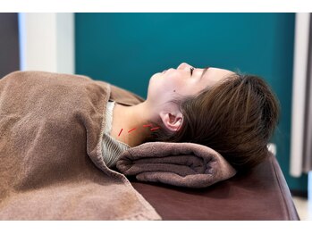 えなわせ接骨院 手稲院/慢性的なコリには鍼灸!