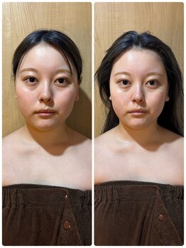 アグレア(Agrea)/頭蓋骨小顔矯正1回の施術♪