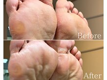 カシェット 広島店(Cachette)/50代女性☆足裏角質ケア90分