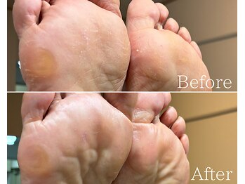 カシェット 広島店(Cachette)/50代女性☆足裏角質ケア90分