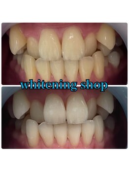 ホワイトニングショップ 日進店/Before After日進ホワイトニング