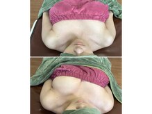 胸が下がってぺたんこだったデコルテに高さが蘇る！