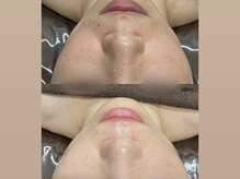 チェルト 鈴鹿店(CERTO)/REVIハーブピーリングくすみケア