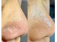 シェノン(Chainon)の写真/【毛穴レスな陶器肌へ】一目でわかる変化！詰まりの原因根本改善。専門店こだわりの毛穴エクストラクション