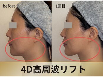 ソルニコン(Solnikon)の写真/【たるみ・ほうれい線・口横ポニョ・二重あご】◆看護師施術の小顔矯正・4D高周波リフトで本格小顔ケア