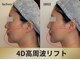 ソルニコン(Solnikon)の写真/【たるみ・ほうれい線・口横ポニョ・二重あご】◆看護師施術の小顔矯正・4D高周波リフトで本格小顔ケア