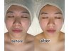 人気No2★【最近顔の変化にお悩みの方に◎】小顔NEO　¥5500