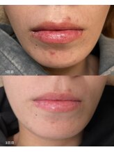 サンク(cinq)/大分初導入!!ララピール☆