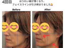 ベル/50代の方の小顔Before After