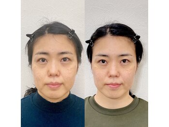 小顔22 ボルティ 本店(Bolty)/30代:小顔シンメトリー(15回)