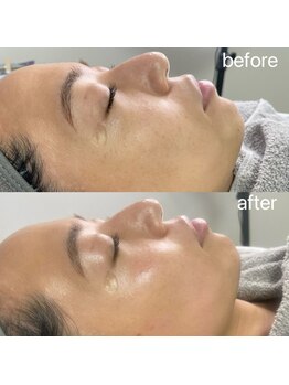 イクスト 吉祥寺(IKUST)/【フェイシャルワックス/脱毛】