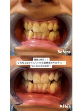 アレッド 大阪店(ared.)/1回でもこの白さ