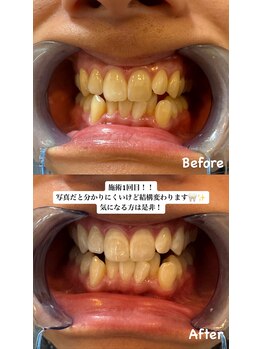 アレッド 大阪店(ared.)/1回でもこの白さ