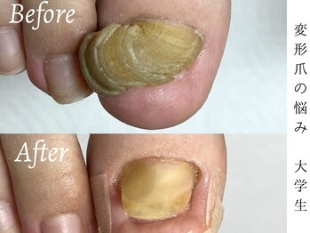肥厚爪・変形爪ケア
