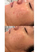 ステージ(Stage)/毛穴洗浄・ハイドラフェイシャル