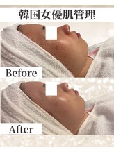 ドレス(dress)/韓国で話題の肌管理施術