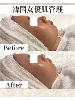 ドレス(dress)/韓国で話題の肌管理施術