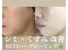 カッカ(kakka)/ハーブピーリング