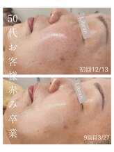 リブラン(Libran)/50代のお客様★赤み＆シミ変化