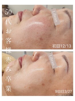 リブラン(Libran)/50代のお客様★赤み&シミ変化