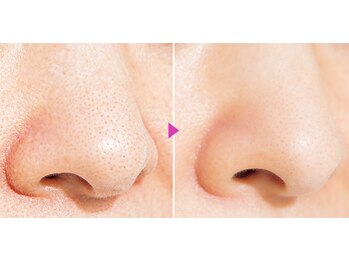 パース(Perth)/毛穴ケア