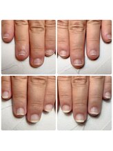 スマイルニコ(smile nico)/超深爪でも1ヶ月でこの伸び！