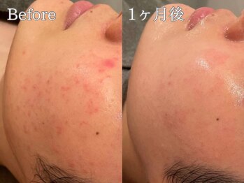 ポポラス(POPOLUS)/ニキビケア1回