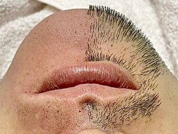 エピファニー(Epi phany Total Beauty Salon)/髭ワックス脱毛/青ヒゲおさらば