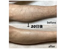 マインドプラス(mind plus)/ハイパワー脱毛もやってます