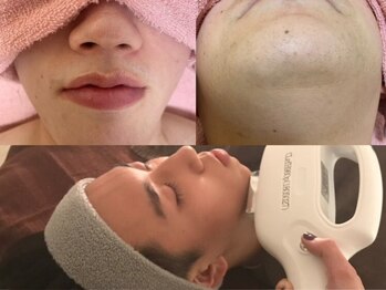 ローランサン(laurencin)の写真/<ヒゲ¥550～/全身¥3300～お試しOK!>全国でも希少なメンズエステティシャン対応◎男性の悩みは男性にお任せ!