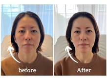 ミラ 中央林間(mira)/小顔　毛穴　ホワイトニング