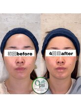 キュープ 相模原淵野辺店(Qpu)/たった4回で人生で1番小さな顔に