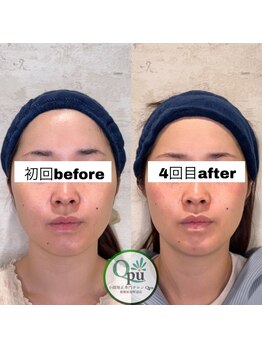 キュープ 相模原淵野辺店(Qpu)/たった4回で人生で1番小さな顔に