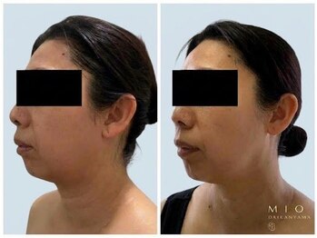 ミオ ダイカンヤマ 代官山(MIO DAIKANYAMA)の写真/本気で小顔を目指す方へ◇結果重視の肌管理
しわ/小顔/たるみ/しわ/造顔/リフトアップ/マッサージ/代官山