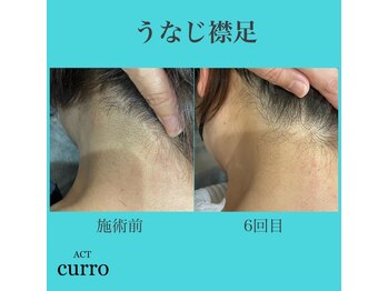 アクト クロ(ACT curro)/【うなじ襟足】脱毛施術例