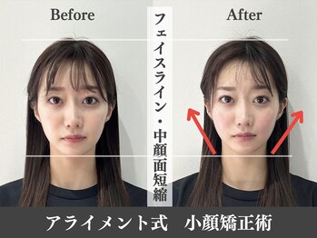 アライメントトウキョウ 表参道(Alignment TOKYO)/フェイスライン改善♪