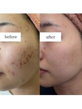 アルル(ARuru)/肌改善症例