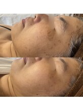 ヴィアス(Vias)/息子さんのご結婚式前のシミケア