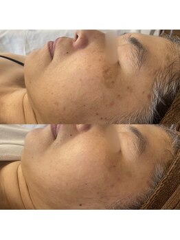 ヴィアス(Vias)/息子さんのご結婚式前のシミケア