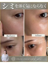 シェリー(Cherie)/【インセルダム】シミを薄くする