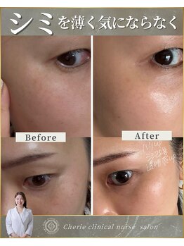 シェリー(Cherie)/【インセルダム】シミを薄くする