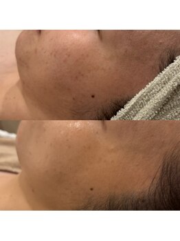 ジャストミービューティー(Just Me Beauty)/肌質改善/毛穴ケア/ニキビケア