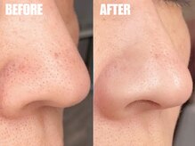 バニッシュ 川口店(VANISH)/気になる小鼻の黒ずみ改善
