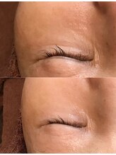 コウベ美容鍼灸治療院(KOBE美容鍼灸治療院)/シワ改善施術３目尻美容液導入