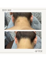 スターチス(Statice)/襟足脱毛　ビフォーアフター