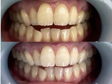 アーティ(aaty)/セルフホワイトニング/白い歯